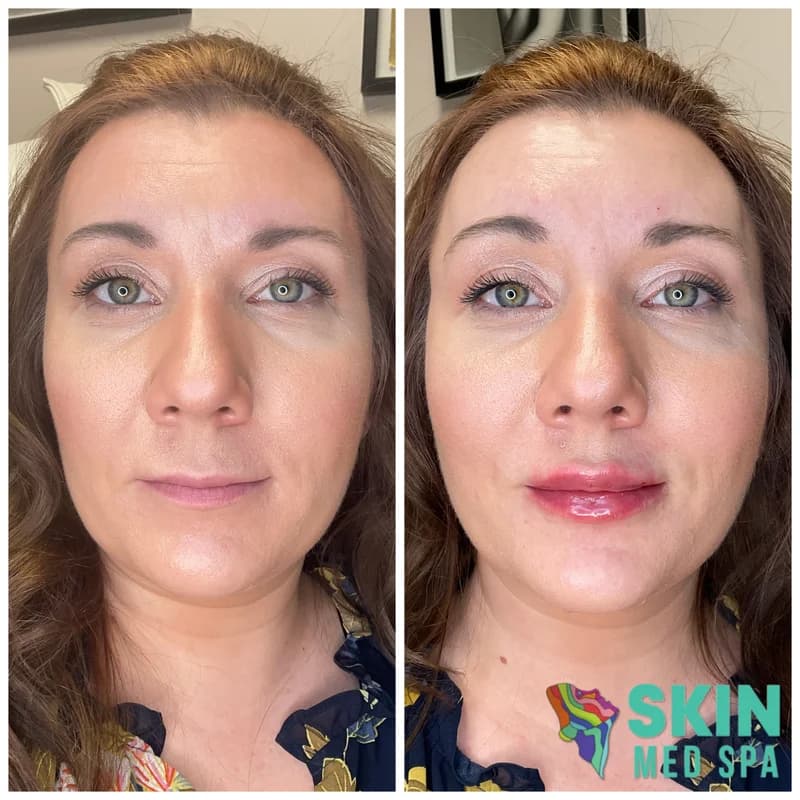 Before and after lip filler results at Skin Med Spa