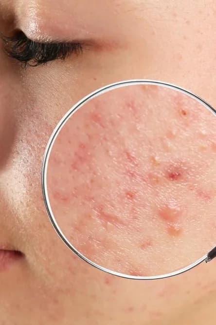 Acne Treatments — Skin at Skin Med Spa